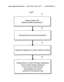 DEVICE FOR TREATING OBESITY diagram and image