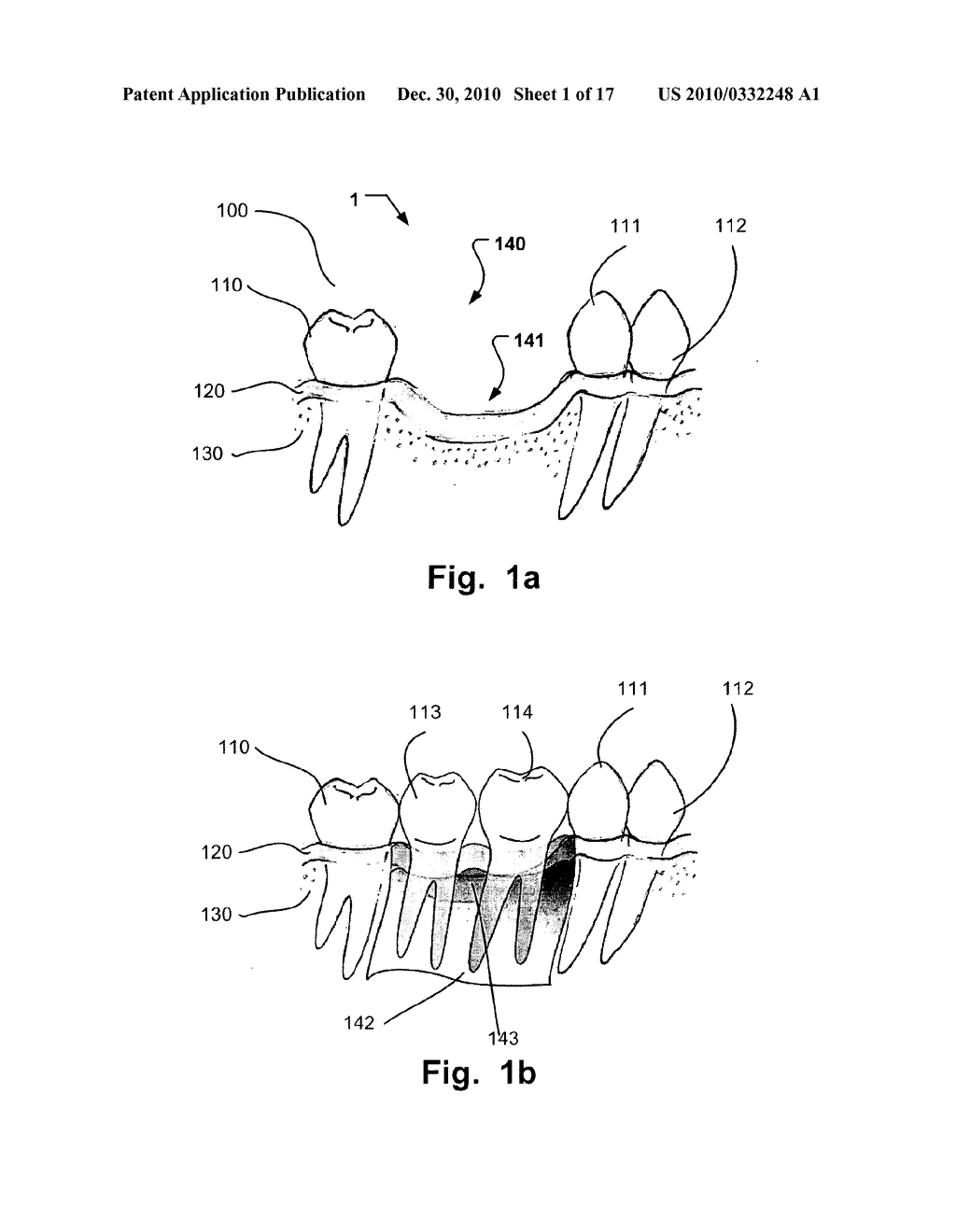 COMPUTER IMPLEMENTED PLANNING AND PROVIDING OF MASS CUSTOMIZED BONE STRUCTURE - diagram, schematic, and image 02