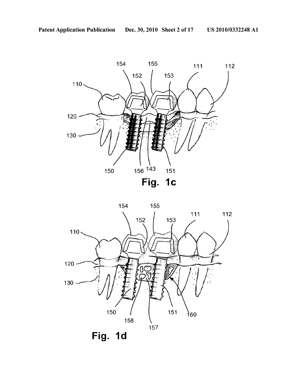 COMPUTER IMPLEMENTED PLANNING AND PROVIDING OF MASS CUSTOMIZED BONE STRUCTURE - diagram, schematic, and image 03