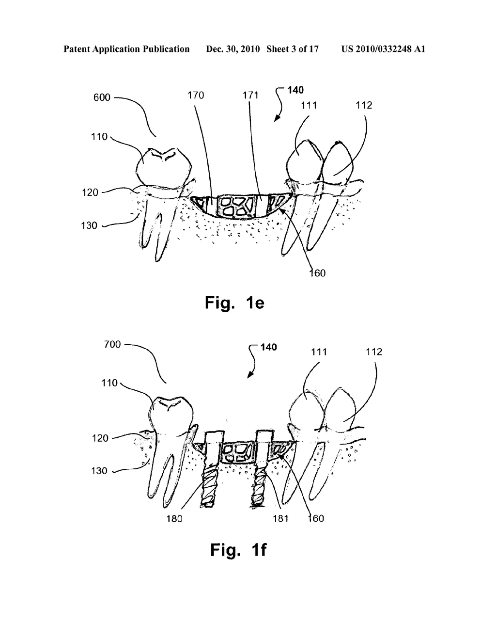 COMPUTER IMPLEMENTED PLANNING AND PROVIDING OF MASS CUSTOMIZED BONE STRUCTURE - diagram, schematic, and image 04