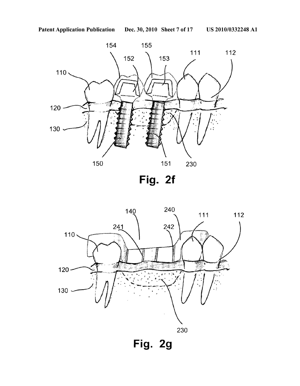 COMPUTER IMPLEMENTED PLANNING AND PROVIDING OF MASS CUSTOMIZED BONE STRUCTURE - diagram, schematic, and image 08