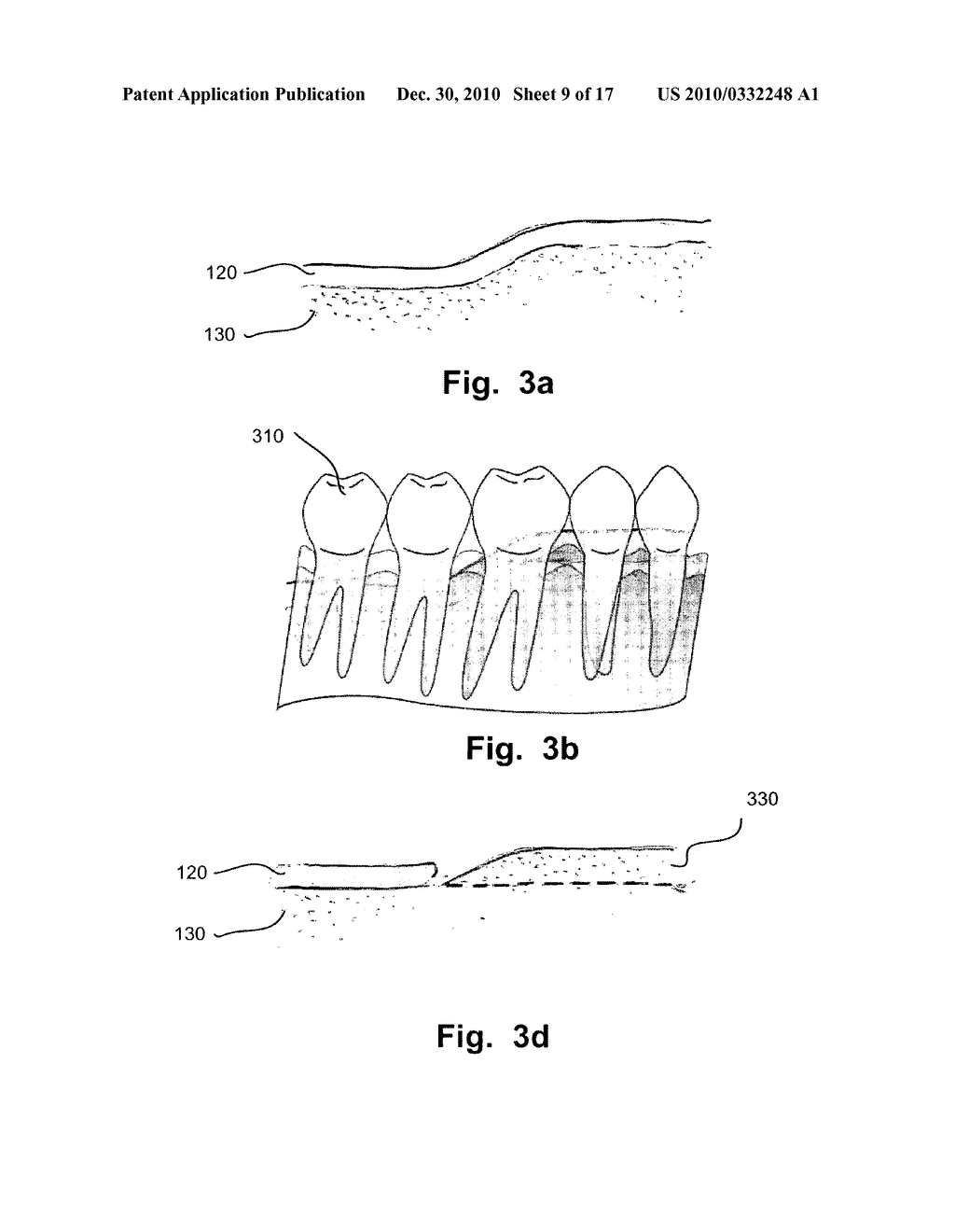 COMPUTER IMPLEMENTED PLANNING AND PROVIDING OF MASS CUSTOMIZED BONE STRUCTURE - diagram, schematic, and image 10