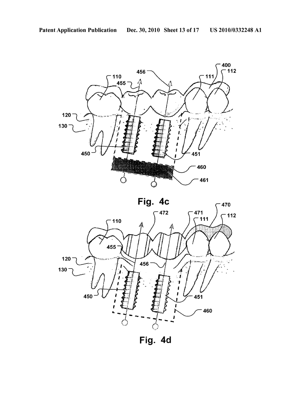 COMPUTER IMPLEMENTED PLANNING AND PROVIDING OF MASS CUSTOMIZED BONE STRUCTURE - diagram, schematic, and image 14