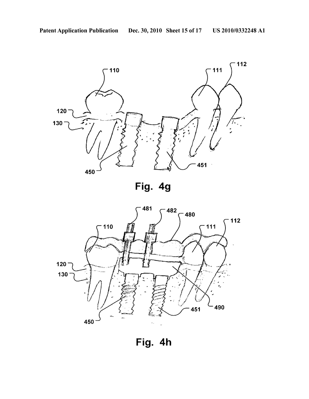 COMPUTER IMPLEMENTED PLANNING AND PROVIDING OF MASS CUSTOMIZED BONE STRUCTURE - diagram, schematic, and image 16