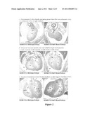 DIAGNOSIS AND TREATMENT OF CONGENITAL HEART DEFECTS USING NELL1 diagram and image