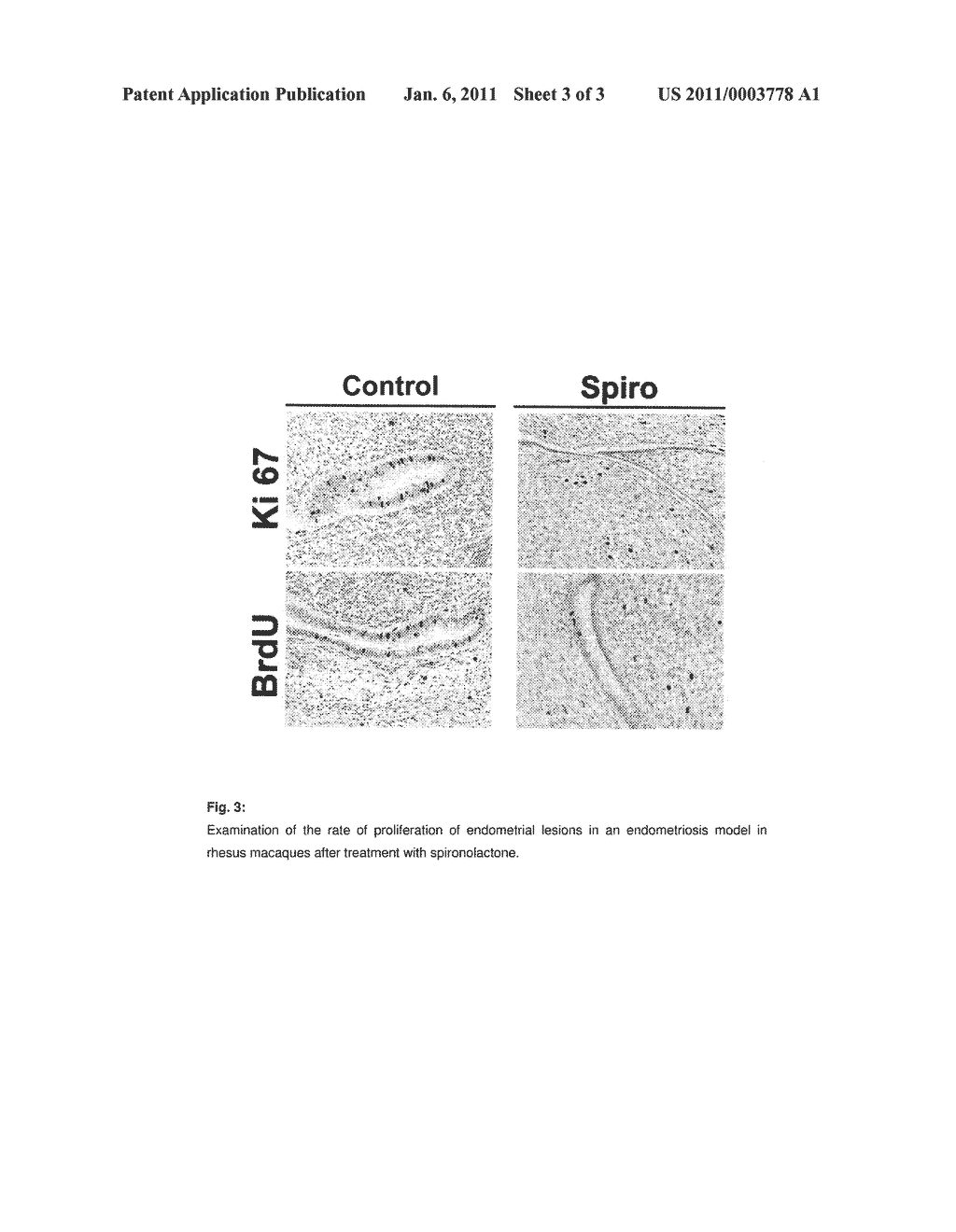 MINERALCORTICOID RECEPTOR ANTAGONISTS FOR THE TREATMENT OF ENDOMETRIOSIS - diagram, schematic, and image 04