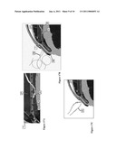  BOLSTER FOR SECURING A SEPTAL SPLINT TO A CARDIAC WALL, A METHOD OF USE THEREOF, AND A SYSTEM INCLUDING THE SAME diagram and image