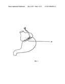 Gastric Constriction Device diagram and image