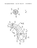 Gastric Constriction Device diagram and image