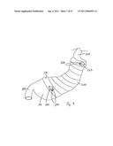 Gastric Constriction Device diagram and image