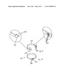 Gastric Constriction Device diagram and image