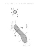 Gastric Constriction Device diagram and image