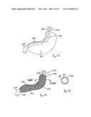 Gastric Constriction Device diagram and image