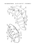 Gastric Constriction Device diagram and image