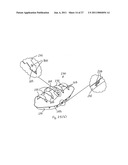 Gastric Constriction Device diagram and image