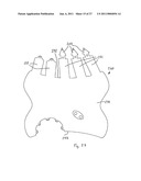 Gastric Constriction Device diagram and image