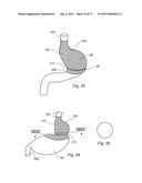Gastric Constriction Device diagram and image