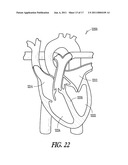 DETECTION OF HYPOVOLEMIA USING IMPLANTABLE MEDICAL DEVICE diagram and image