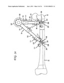 Apparatus and Method for Use With Fracture Table to Reposition Bone Portions diagram and image