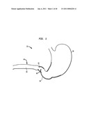 Systems and Methods for Treating Obesity and Type 2 Diabetes diagram and image