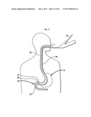 Systems and Methods for Treating Obesity and Type 2 Diabetes diagram and image