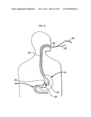 Systems and Methods for Treating Obesity and Type 2 Diabetes diagram and image