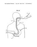 Systems and Methods for Treating Obesity and Type 2 Diabetes diagram and image