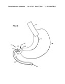 Systems and Methods for Treating Obesity and Type 2 Diabetes diagram and image