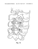 SPINAL FIXATION SYSTEM diagram and image