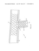 Bifurcated Stent and Delivery System diagram and image