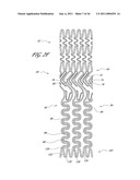 OSTIUM SUPPORT FOR TREATING VASCULAR BIFURCATIONS diagram and image