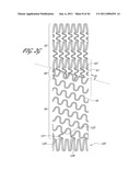 OSTIUM SUPPORT FOR TREATING VASCULAR BIFURCATIONS diagram and image