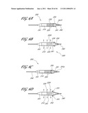 OSTIUM SUPPORT FOR TREATING VASCULAR BIFURCATIONS diagram and image