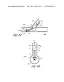 OSTIUM SUPPORT FOR TREATING VASCULAR BIFURCATIONS diagram and image