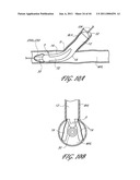 OSTIUM SUPPORT FOR TREATING VASCULAR BIFURCATIONS diagram and image