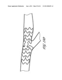 OSTIUM SUPPORT FOR TREATING VASCULAR BIFURCATIONS diagram and image