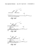 OSTIUM SUPPORT FOR TREATING VASCULAR BIFURCATIONS diagram and image