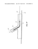 OSTIUM SUPPORT FOR TREATING VASCULAR BIFURCATIONS diagram and image