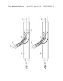 OSTIUM SUPPORT FOR TREATING VASCULAR BIFURCATIONS diagram and image