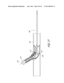 OSTIUM SUPPORT FOR TREATING VASCULAR BIFURCATIONS diagram and image