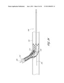 OSTIUM SUPPORT FOR TREATING VASCULAR BIFURCATIONS diagram and image