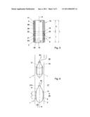 Implant valve for implantation in a blood vessel diagram and image