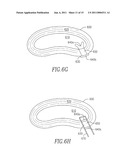 SHAPED IMPLANTS FOR TISSUE REPAIR diagram and image