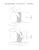 METHOD AND APPARATUS FOR THERAPEUTICALLY SUPPORTING THE ARM OF A PATIENT diagram and image