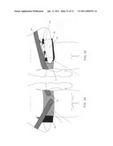 METHOD AND APPARATUS FOR THERAPEUTICALLY SUPPORTING THE ARM OF A PATIENT diagram and image