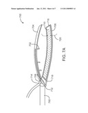 LEFT ATRIAL APPENDAGE DEVICES AND METHODS diagram and image