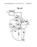 METHOD AND DEVICE FOR THREE-STAGE ATRIAL CARDIOVERSION THERAPY diagram and image