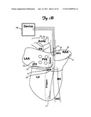 METHOD AND DEVICE FOR THREE-STAGE ATRIAL CARDIOVERSION THERAPY diagram and image