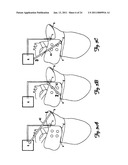 METHOD AND DEVICE FOR THREE-STAGE ATRIAL CARDIOVERSION THERAPY diagram and image