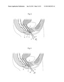 VAGINAL OPERATION METHOD FOR THE TREATMENT OF ANAL INCONTINENCE IN WOMEN diagram and image